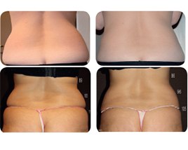 Comparativo de região abdominal publicado na página de criolipólise