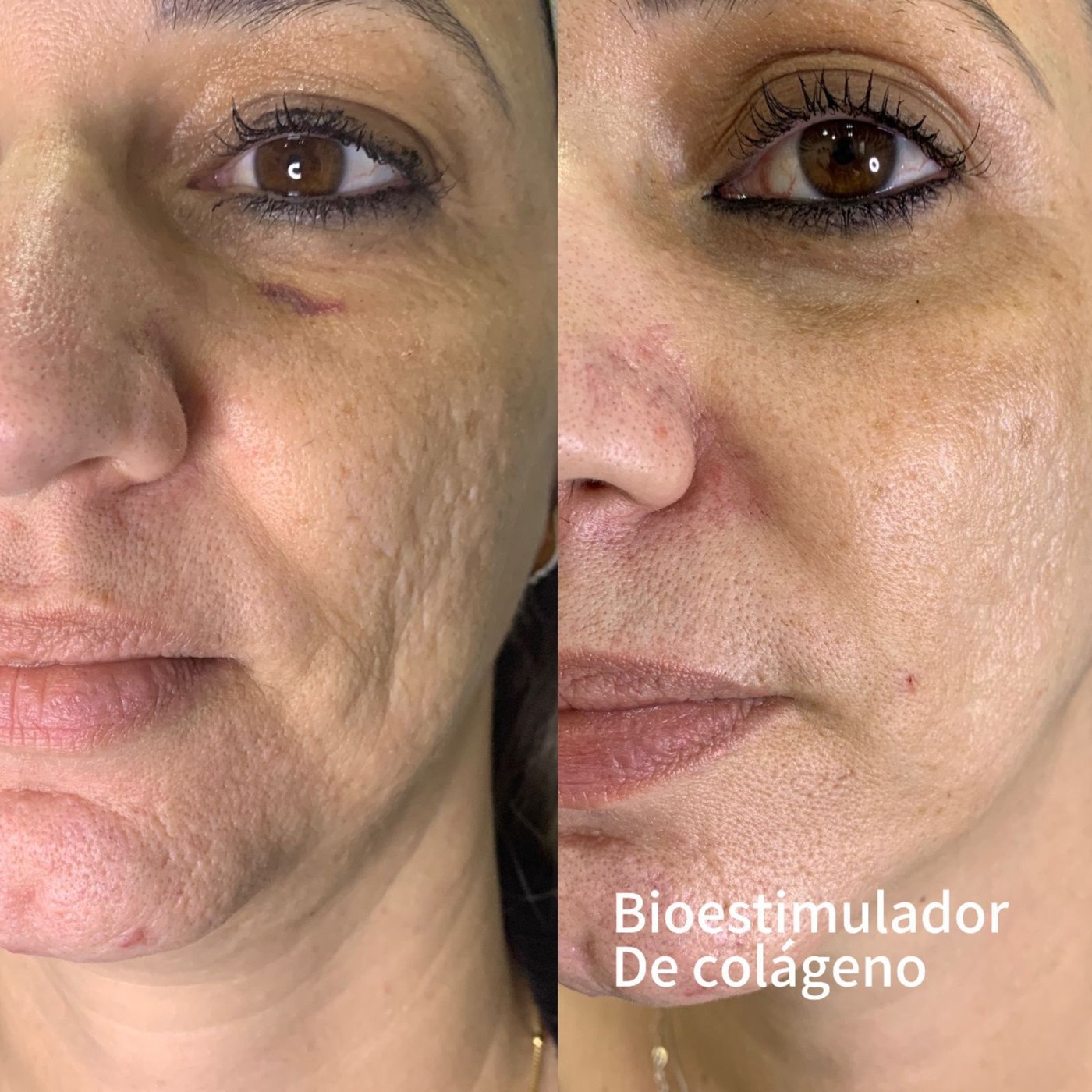 Comparativo publicado na seção de bioestimuladores de colágeno