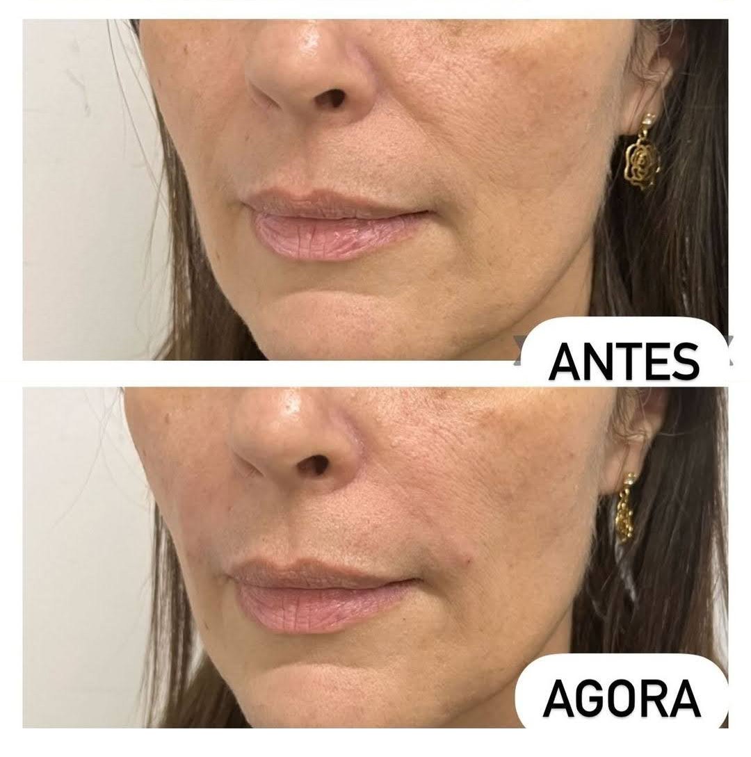 Comparativo de preenchimento facial publicado no site