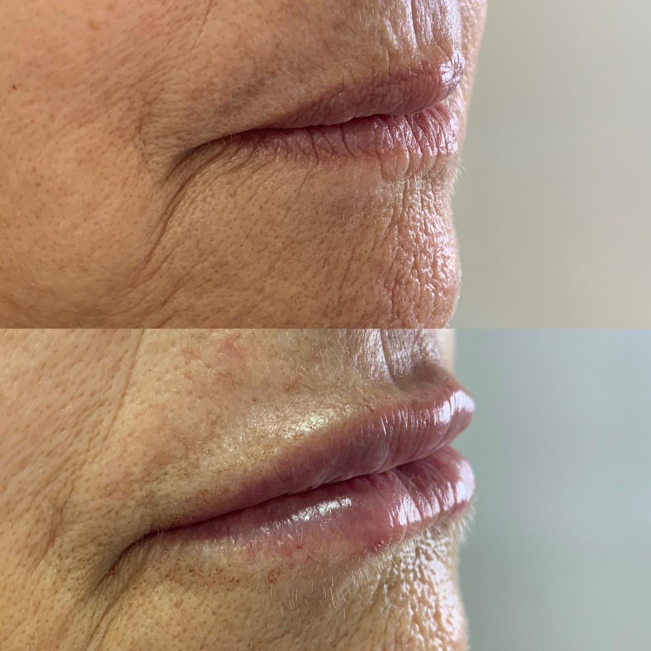 Comparativo de preenchimento labial publicado no site