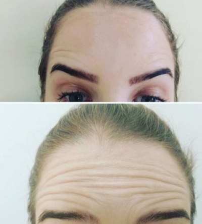 Comparativo facial publicado na página de toxina botulínica